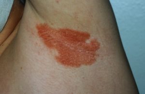 Inverse psoriasis treatment - Account Options
