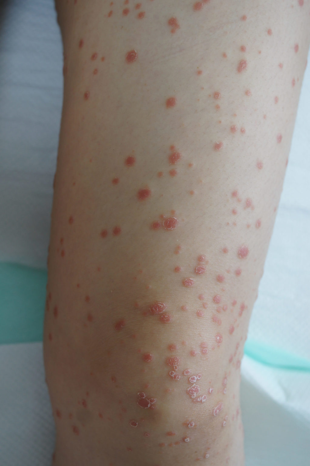 article-about-a-viral-infection-on-craiyon