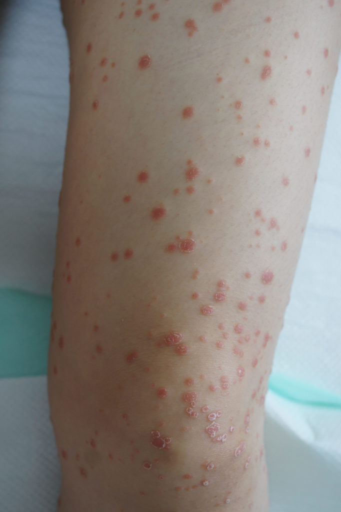 Psoriasis treatment while pregnant