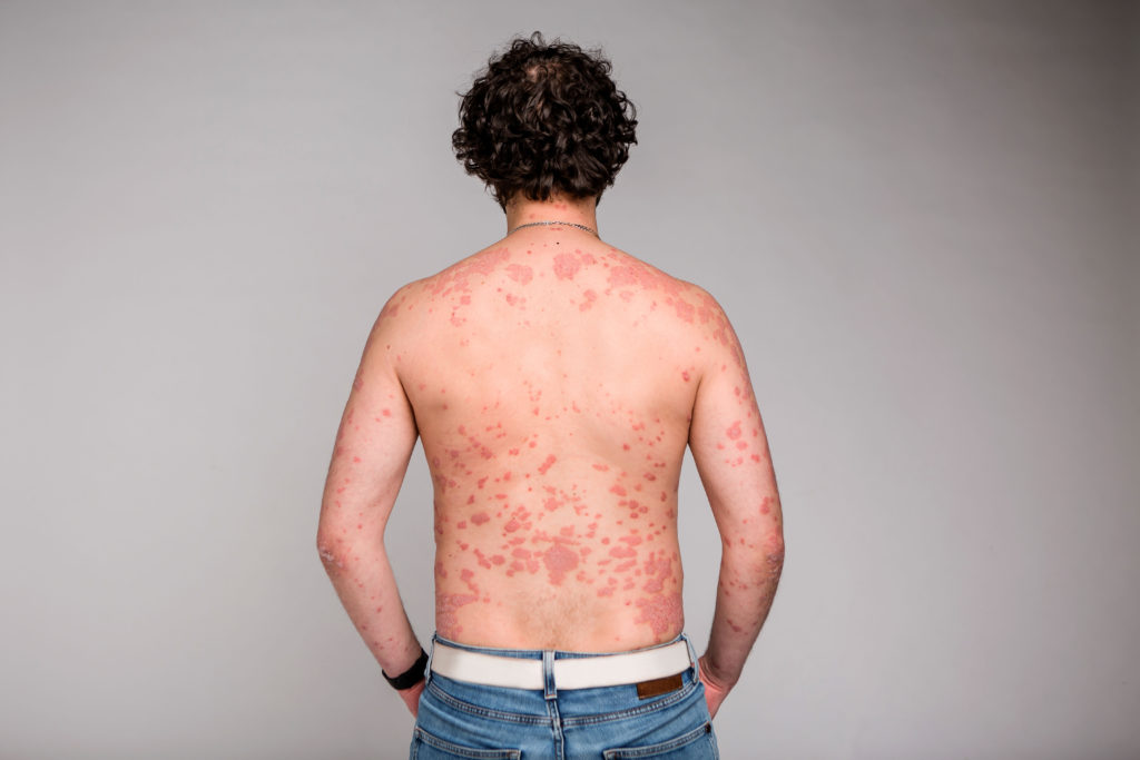 a-look-at-psoriasis-harvard-health